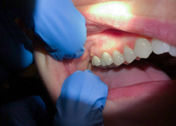 Best Cracked Tooth Emergency Dentist  in Cascade Valley, WA