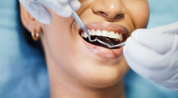 Best Teeth Whitening  in Cascade Valley, WA