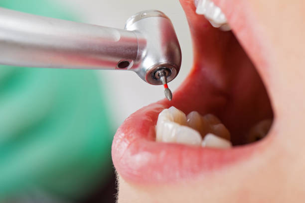 Best Knocked-Out Tooth Emergency  in Cascade Valley, WA